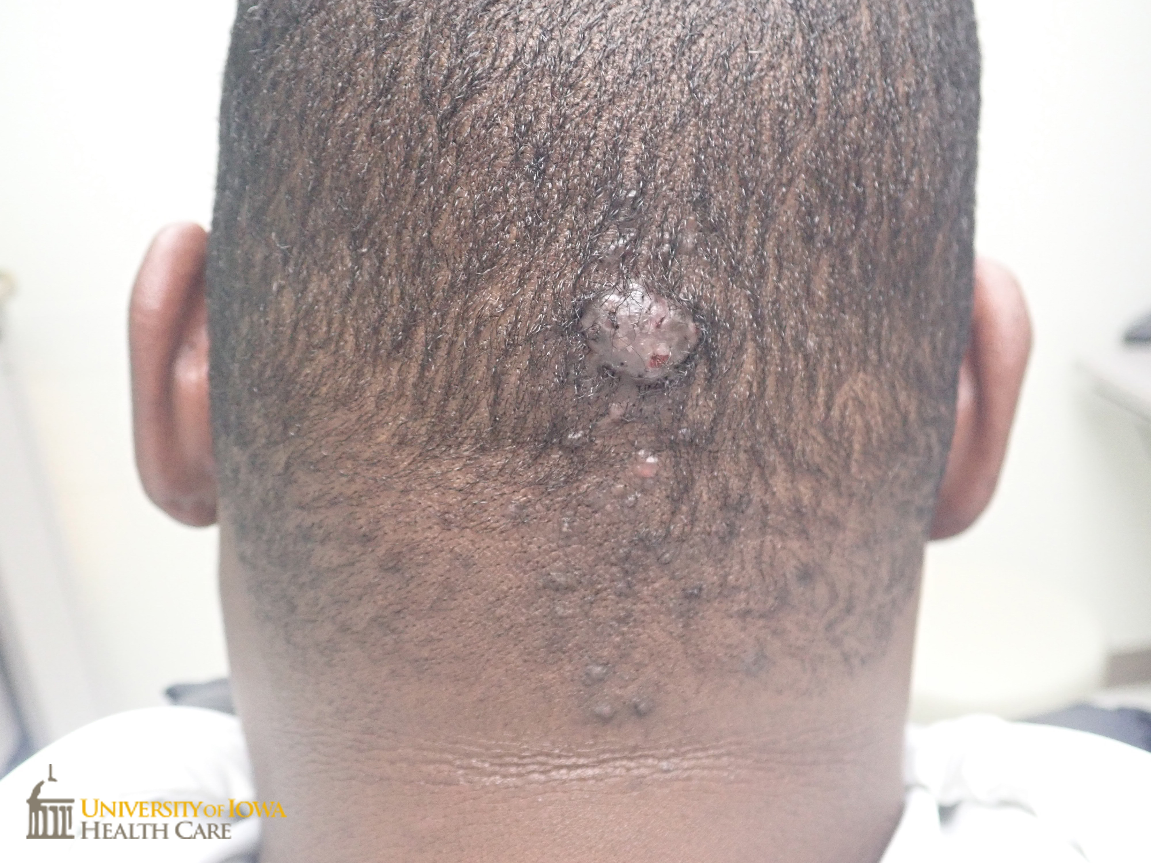 Pink keloidal papules  and nodule on the occipital scalp. (click images for higher resolution).